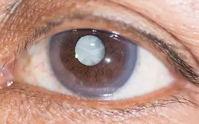 Cirurgia de Catarata  é na Vítrea Clínica de Olhos em Guarapari