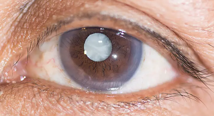 Cirurgia de Catarata  é na Vítrea Clínica de Olhos em Guarapari