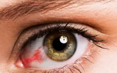 Cirugia de Pterígio em Guarapari é na Vítrea Hospital de Olhos – Oftalmologista