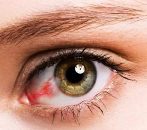 Cirugia de Pterígio em Guarapari é na Vítrea Clínica de Olhos – Oftalmologista
