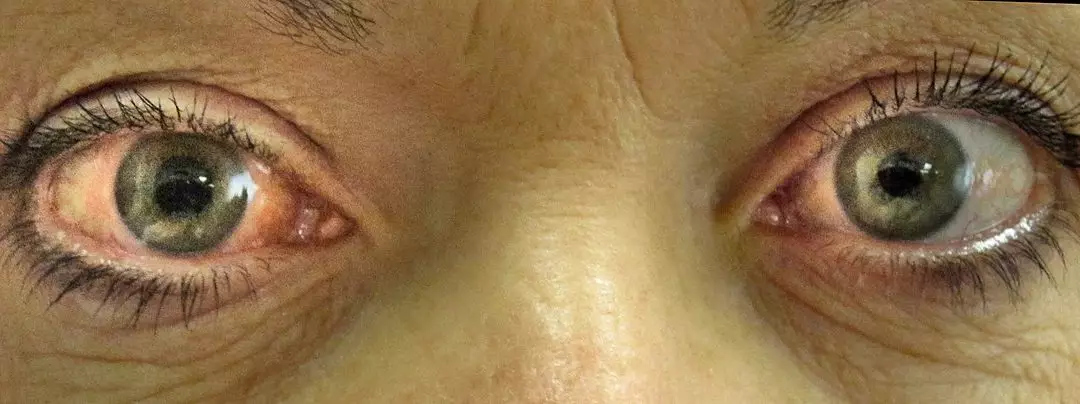 Glaucoma (Guarapari Vítrea)