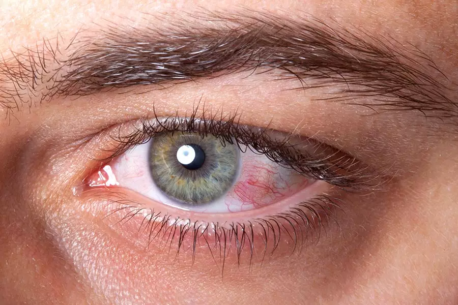 A uveíte é a inflamação da úvea, camada média do olho que consiste na íris, corpo ciliar e coróide.