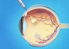 Injeção Intravitrea oftalmologia